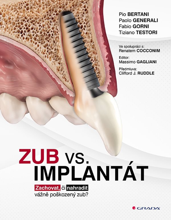 Zub vs. implantát