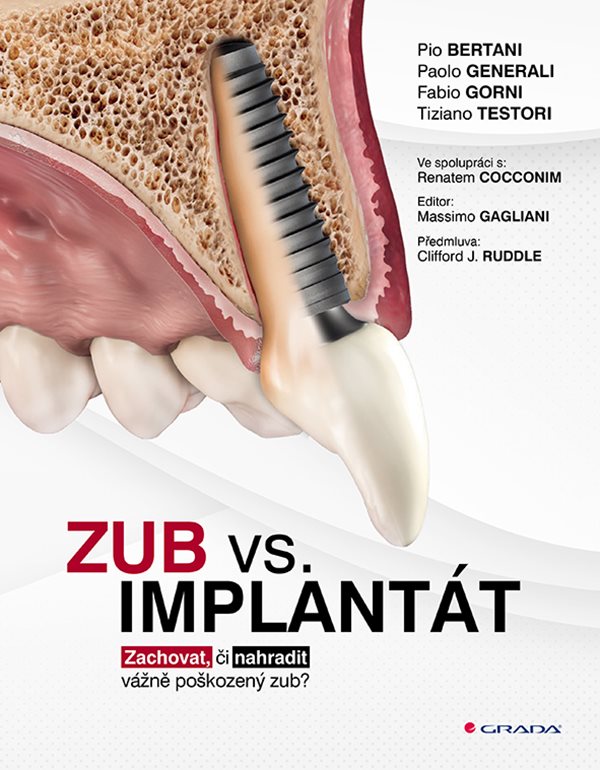 Zub vs. implantát